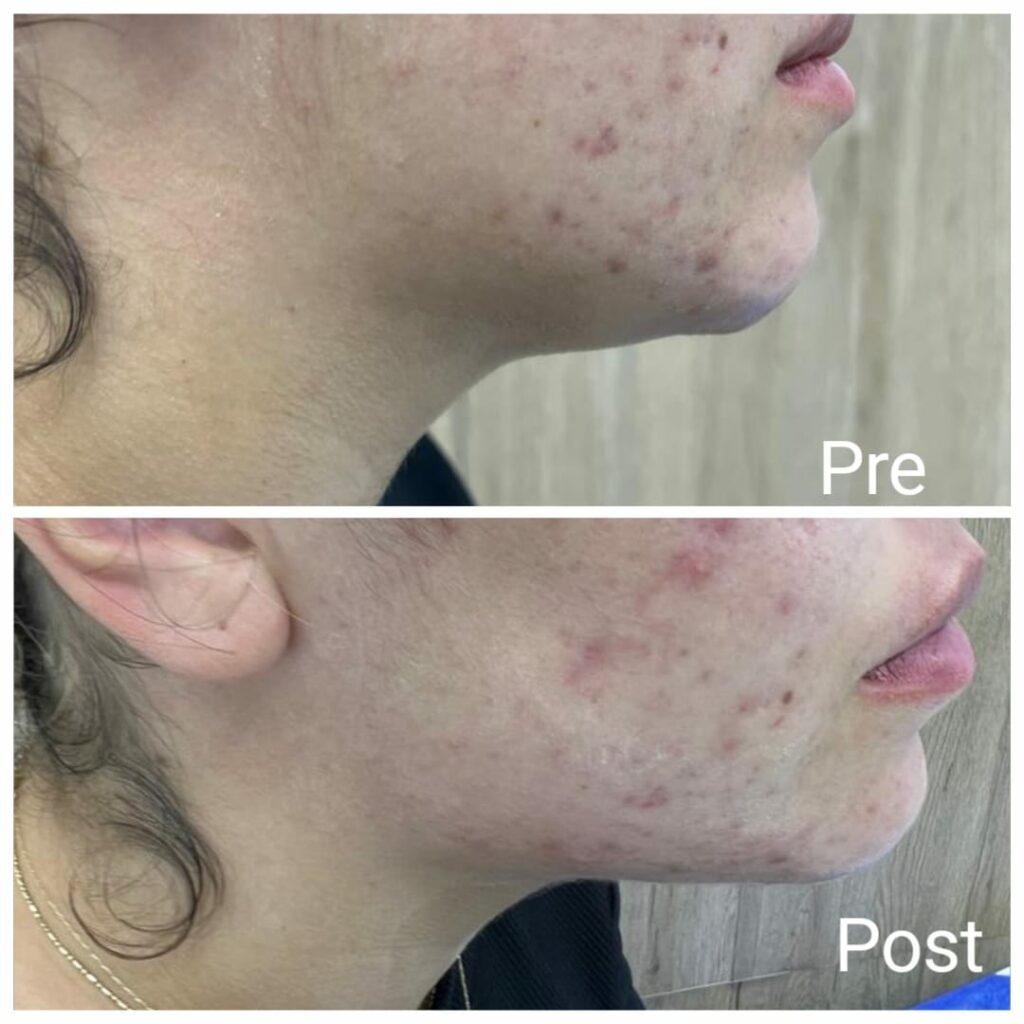 Double chin treatment in Hurghada